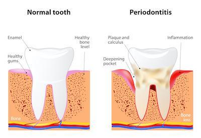 Periodontitis diagram | Garran dentist