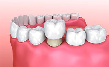 diagram of dental crown in garran