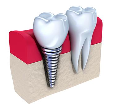 Animated view of two teeth with dental implants, Garran ACT
