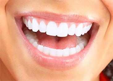 woman after teeth whitening in garran