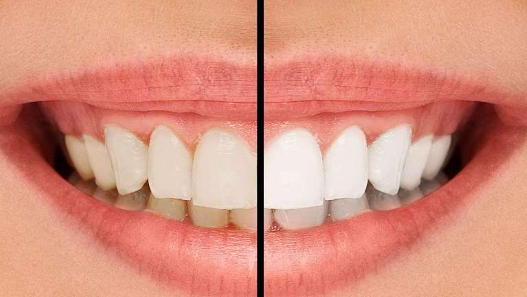 teeth whitening services, Garran ACT