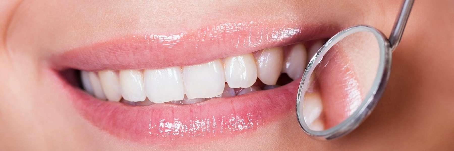 teeth whitening after