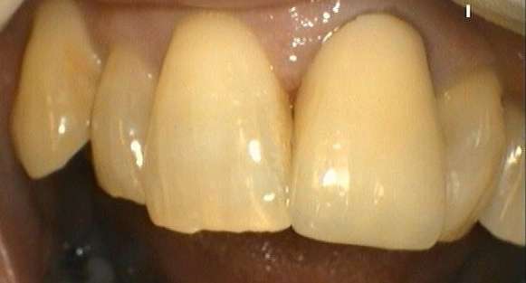 after picture of ceramic (zirconia) crown, Garran ACT