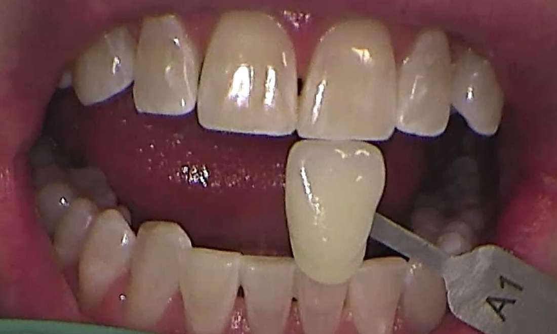 After zoom teeth whitening services, Canberra ACT