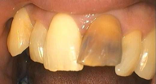 before picture of ceramic (zirconia) crown, Garran ACT