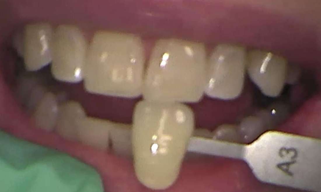 Before zoom teeth whitening services, Canberra ACT