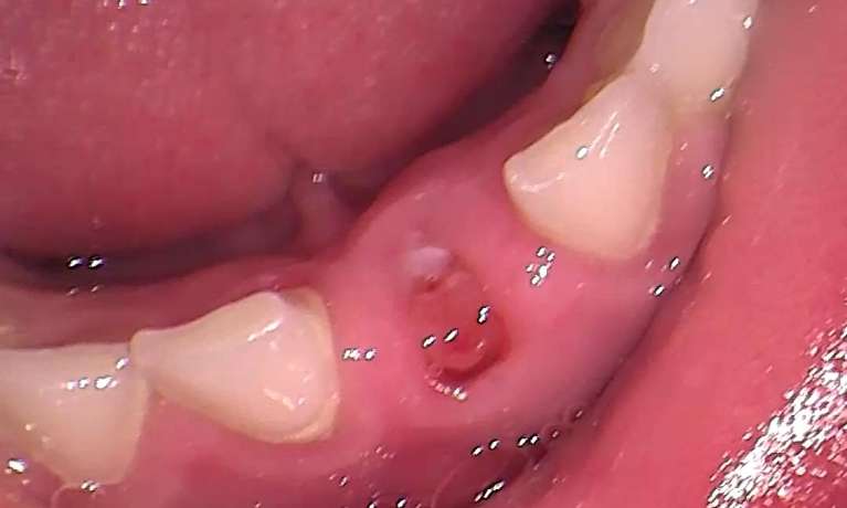 Baby-Tooth-Extraction-After-Image