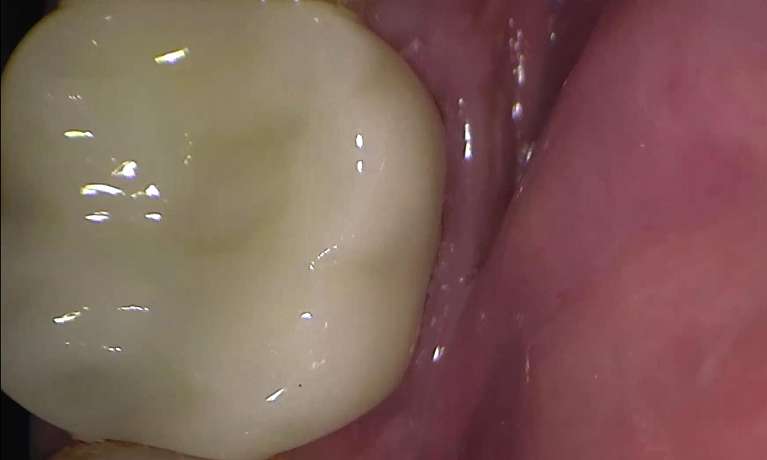 Broken-Same-Day-Crown-Replaced-With-High-Strength-100-Ultra-Translucent-Zirconia-Ceramic-After-Image