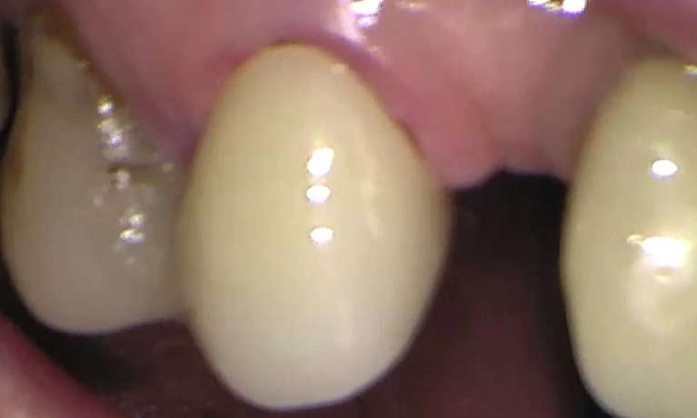 Broken-Same-Day-Crown-Replaced-With-High-Strength-Monolithic-Zirconia-Ceramic-After-Image