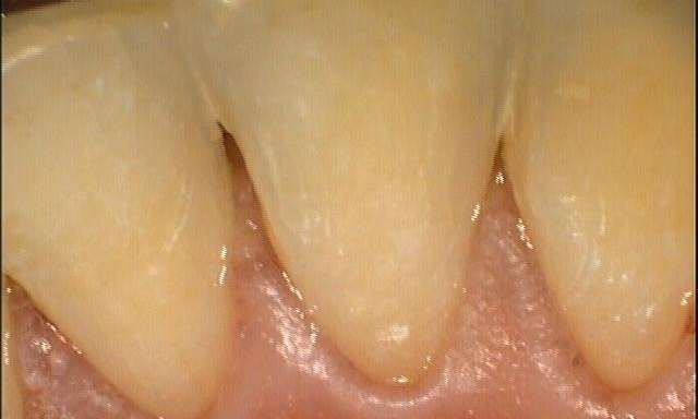 after dental cleaning, Canberra ACT