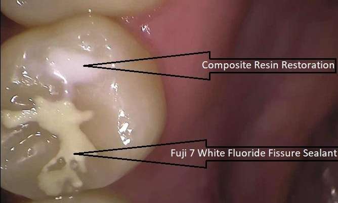 after composite resin filling & gic fissure sealant, Garran ACT
