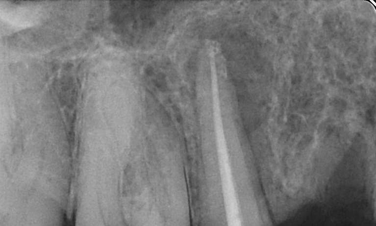 after root canal therapy and tooth extraction, Garran ACT
