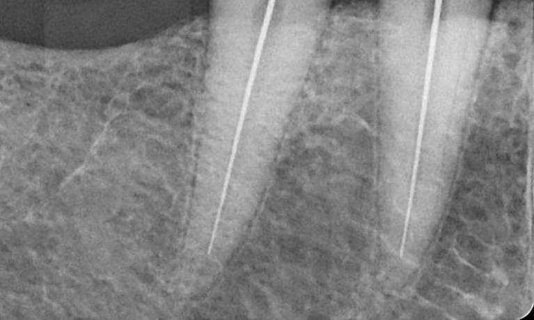 after root canal therapy, Canberra ACT