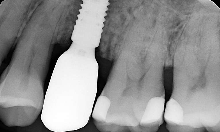 after dental implant, Canberra ACT