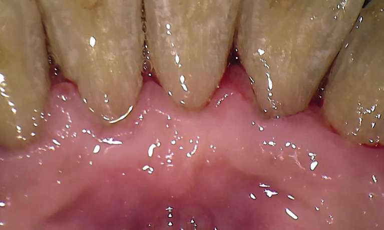First-Dental-Cleaning-After-Image