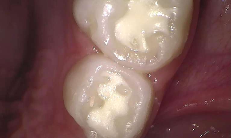 Fissure-Sealants-GIC-After-Image