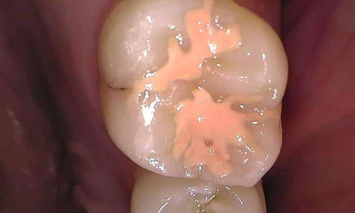 child after fissure sealants - GIC, Garran ACT