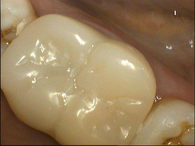 after hybrid ceramic restoration of lower molar, Garran ACT