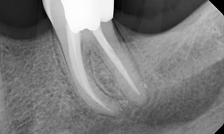 after root canal therapy, Canberra ACT
