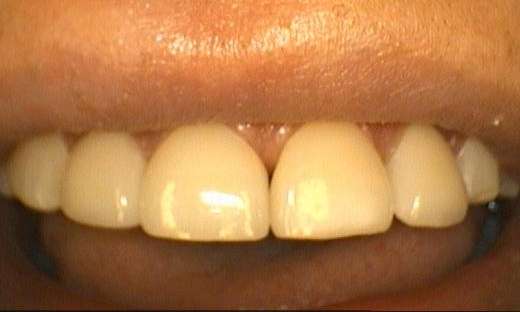 after no prep porcelain veneers, Garran ACT