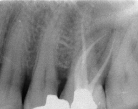 after root canal therapy, Canberra ACT