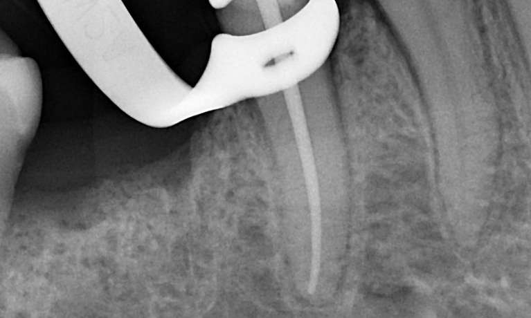 after root canal therapy, Garran ACT