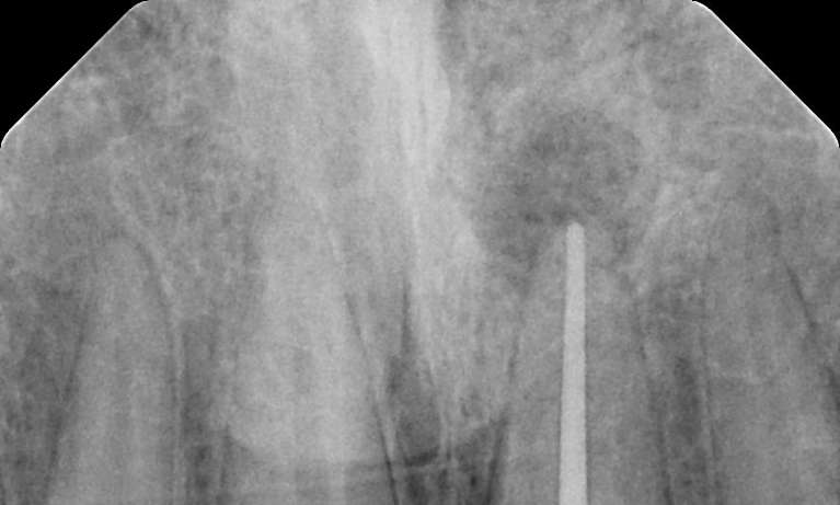 after root canal therapy, Garran ACT