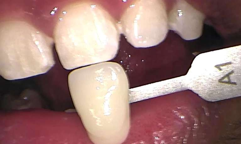 After zoom teeth whitening services, Garran ACT