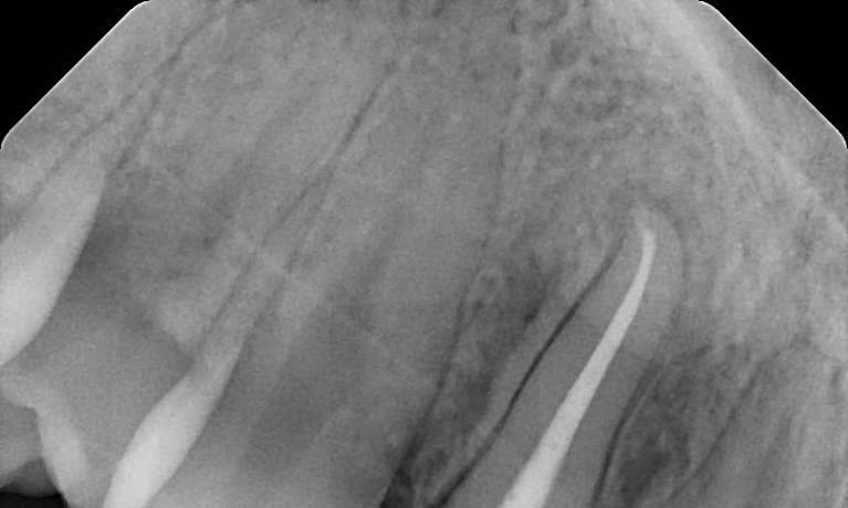 after root canal therapy, Garran ACT