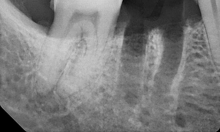 after emergency tooth extraction, Canberra ACT