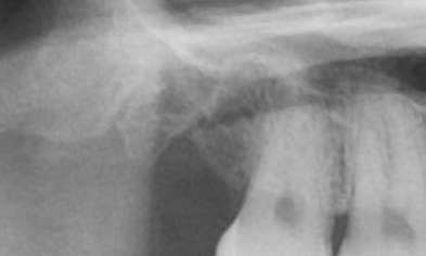 After wisdom tooth extraction, Canberra ACT