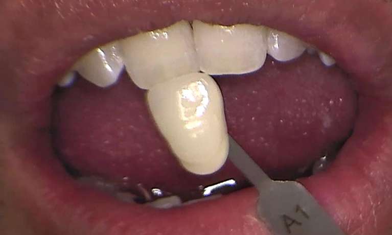 After zoom teeth whitening services, Canberra ACT