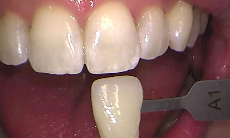 After zoom teeth whitening services, Garran ACT