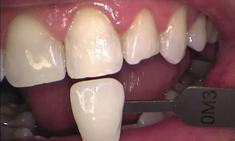 After zoom teeth whitening, Garran ACT