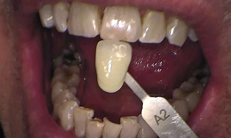 After zoom teeth whitening services, Canberra ACT