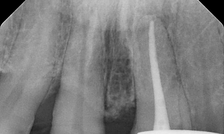 after root canal therapy x-ray, Garran ACT
