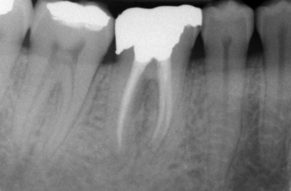 after root canal therapy, Canberra ACT