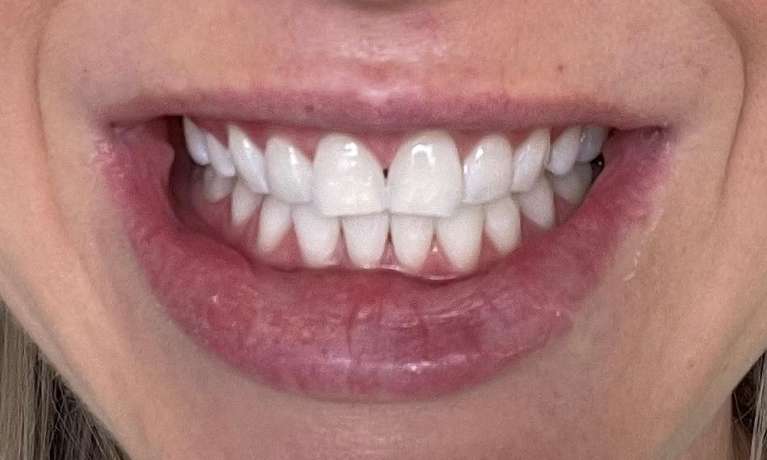 Zoom-In-chair-Teeth-Whitening-After-Image
