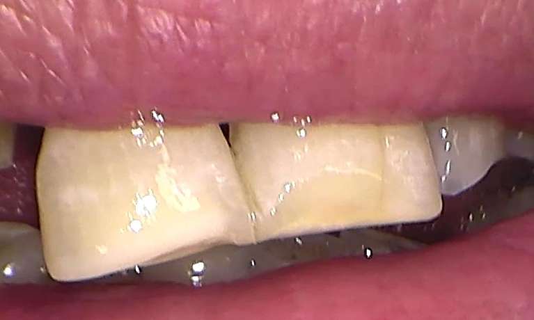 after root canal and non vital bleaching, Garran ACT