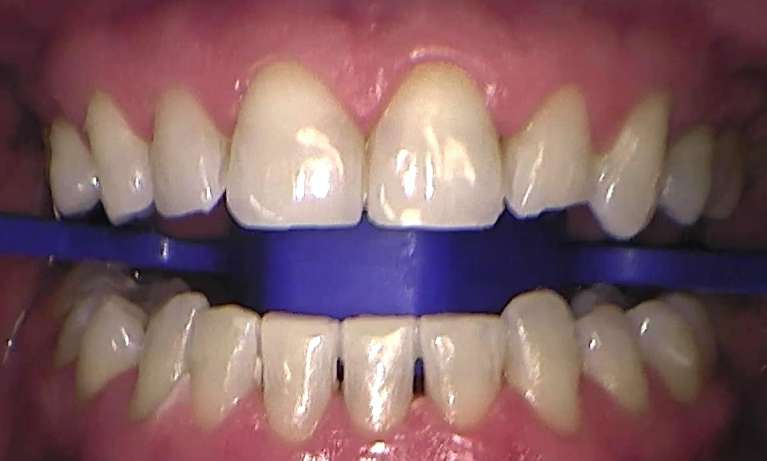 Professional-Teeth-Cleaning-After-Image