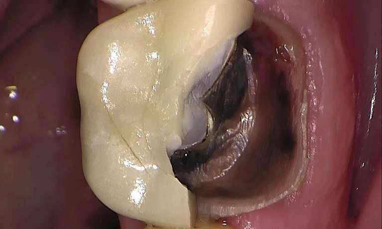 Broken-Same-Day-Crown-Replaced-With-High-Strength-100-Ultra-Translucent-Zirconia-Ceramic-Before-Image