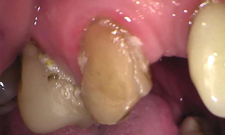 Broken-Same-Day-Crown-Replaced-With-High-Strength-Monolithic-Zirconia-Ceramic-Before-Image