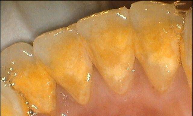 before dental cleaning, Canberra ACT