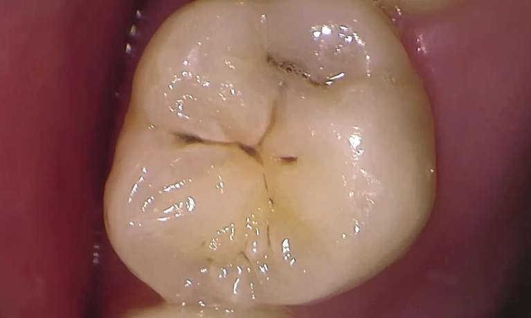 before composite resin filling & gic fissure sealant, Garran ACT