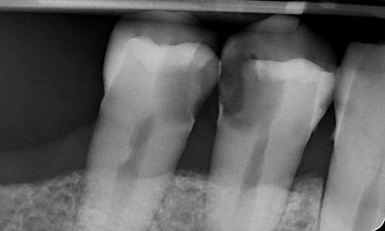before root canal therapy, Canberra ACT