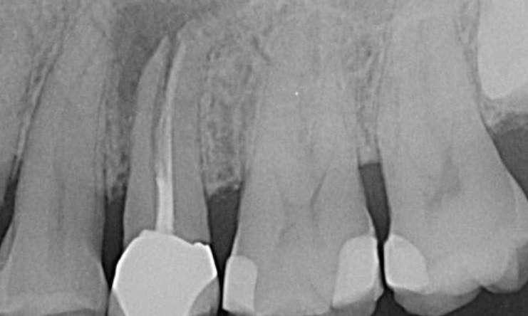 before dental implant, Canberra ACT