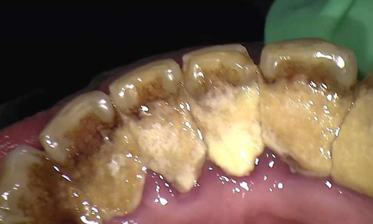 First-Dental-Cleaning-Before-Image
