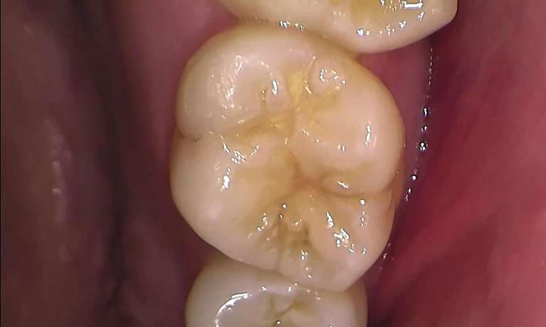child before fissure sealants - GIC, Garran ACT