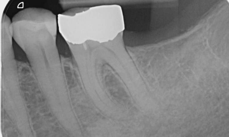 before implant in lower molar, Garran ACT