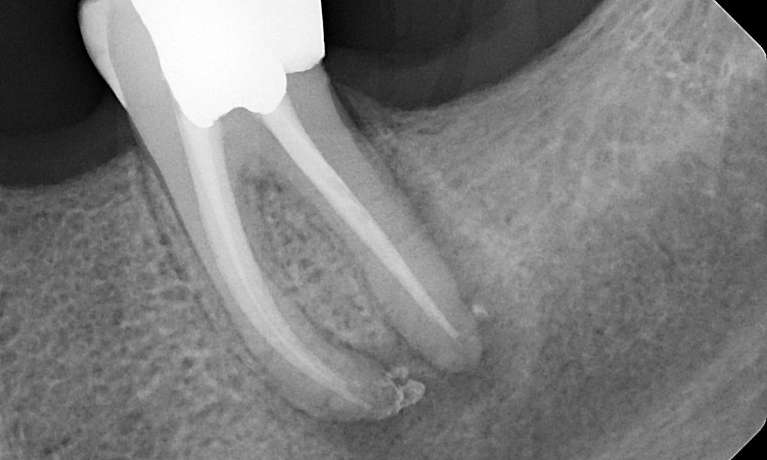 before root canal therapy, Canberra ACT